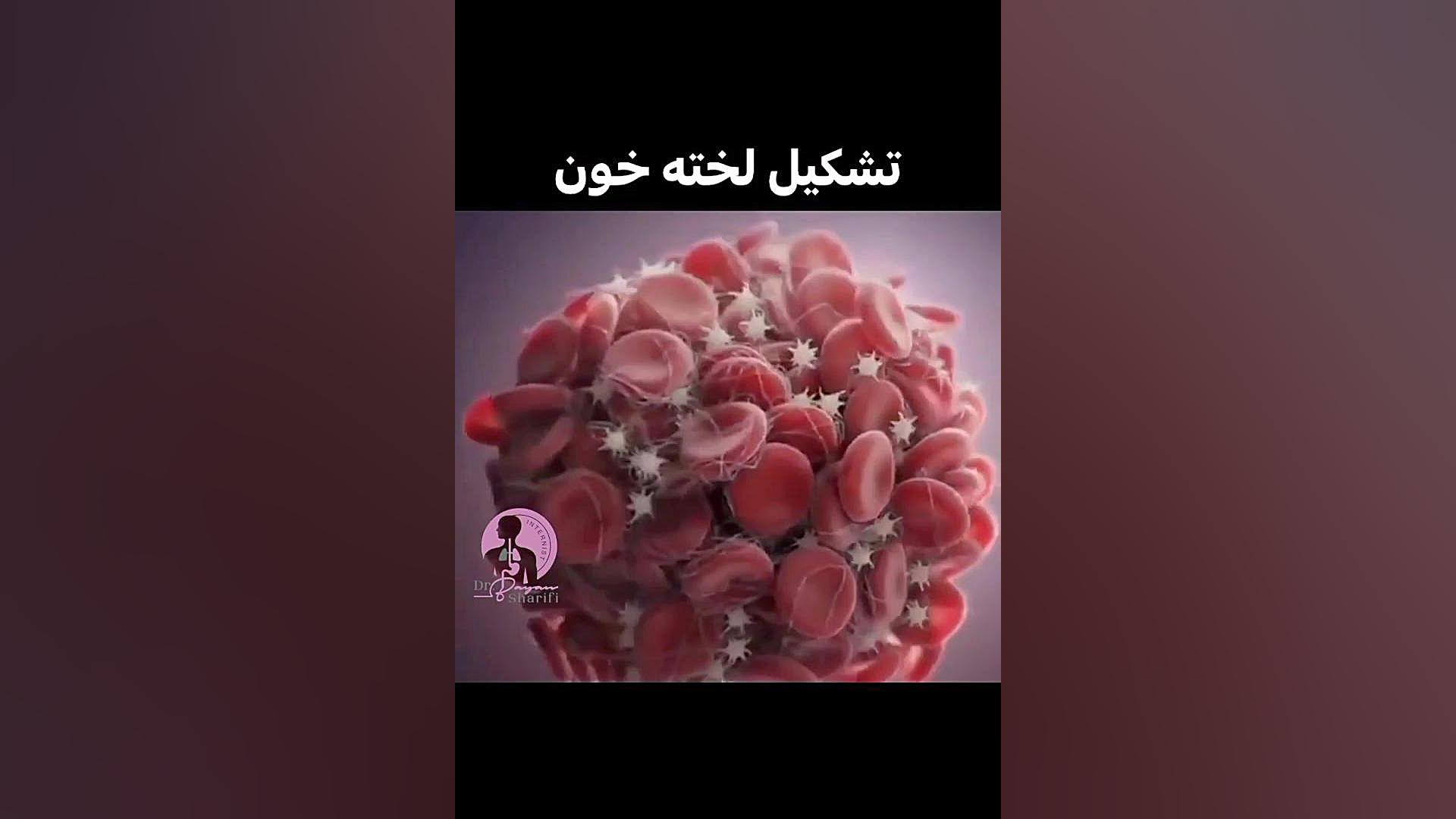 تشکیل لخته خون دکتر بیان شریفی-متخصص بیماری های داخلی