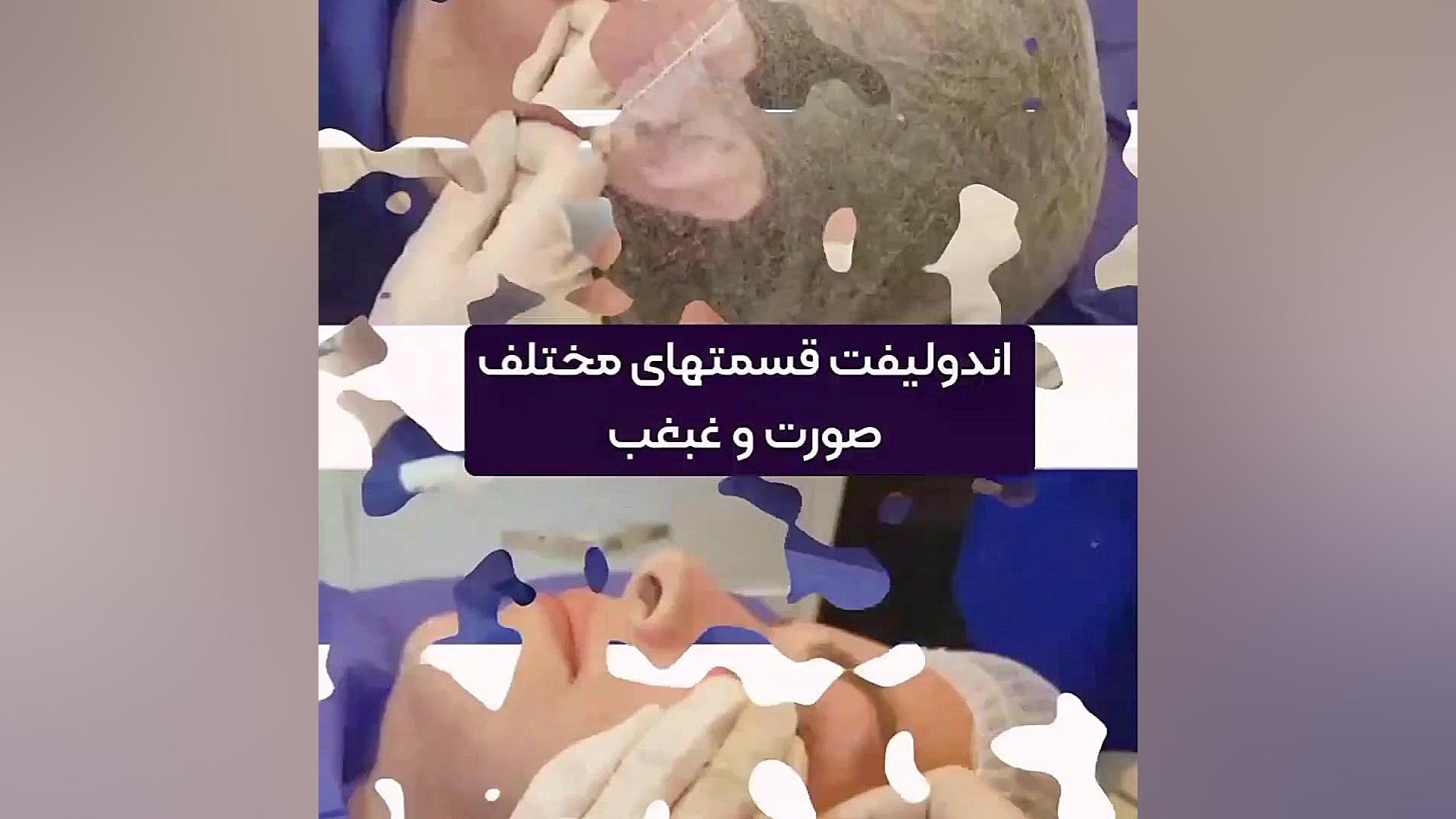 اندولیفت صورت و غبغب دکتر حمیده آقایی
