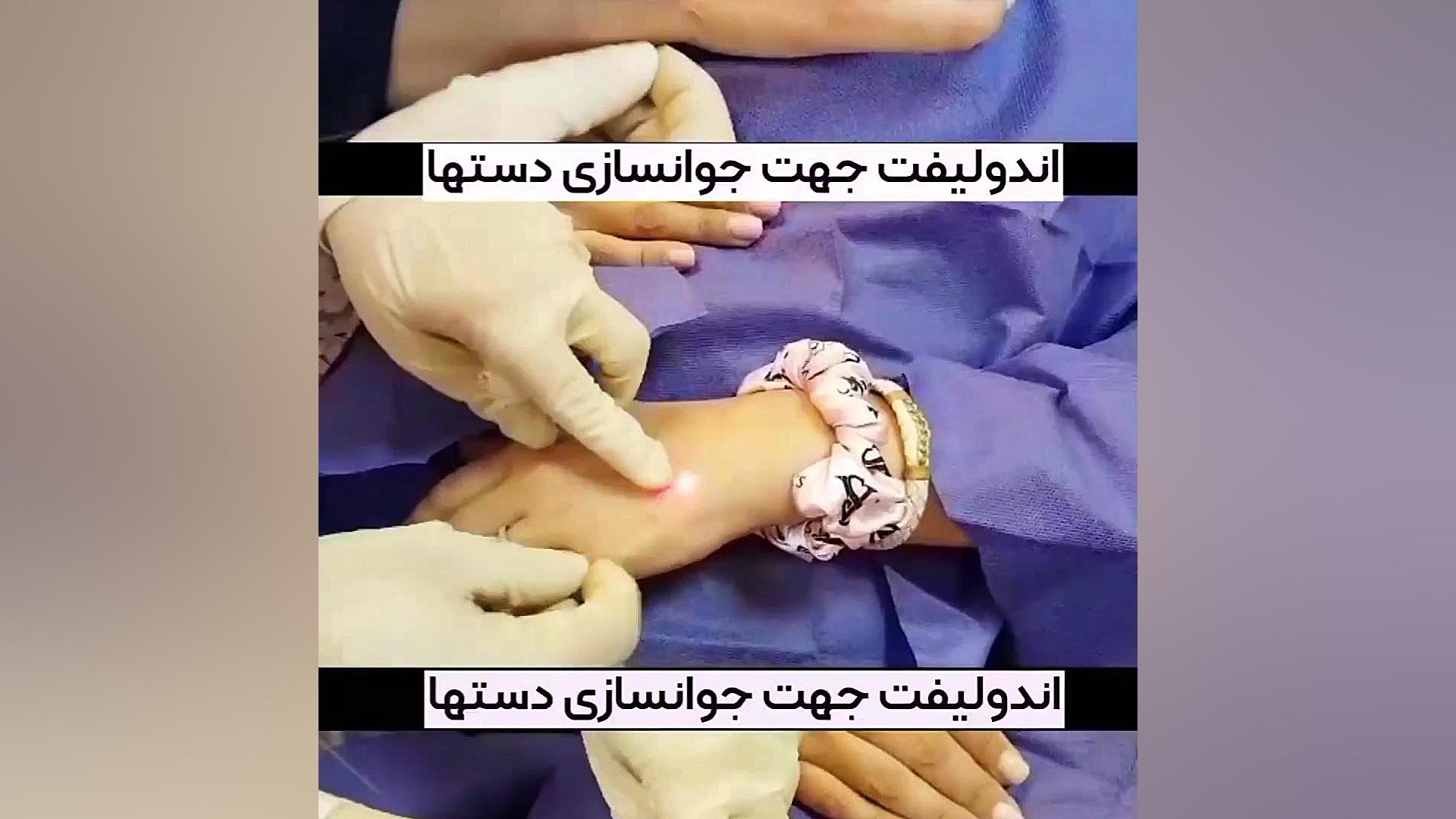 تاثیر اندولیفت بر جوانسازی دست ها دکتر حمیده آقایی
