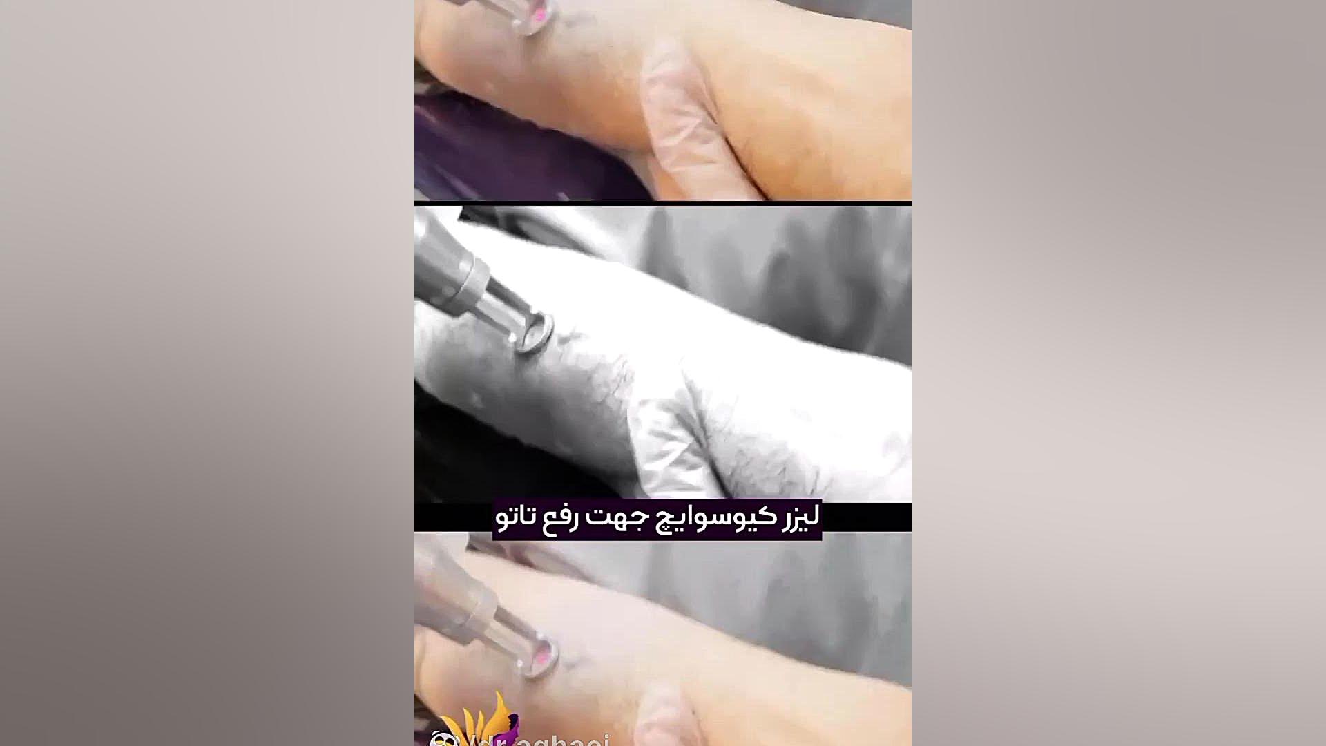 فیلم ریموو تتو با لیزر دکتر حمیده آقایی