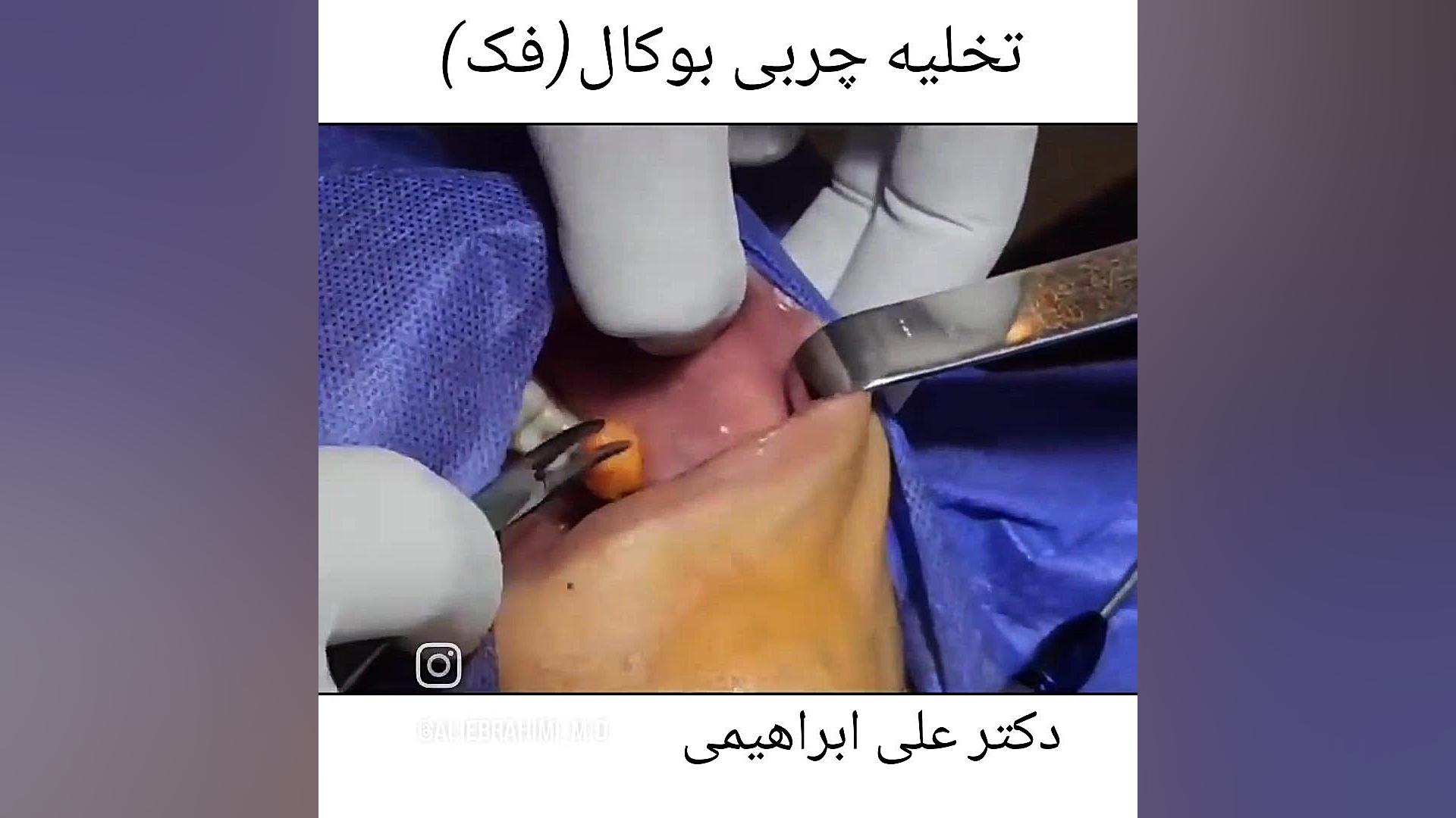 تخلیه چربی بوکال دکتر علی ابراهیمی فوق تخصص جراحی پلاستیک .