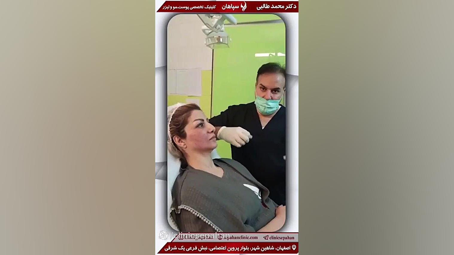 لیفت صورت با نخ FEV1