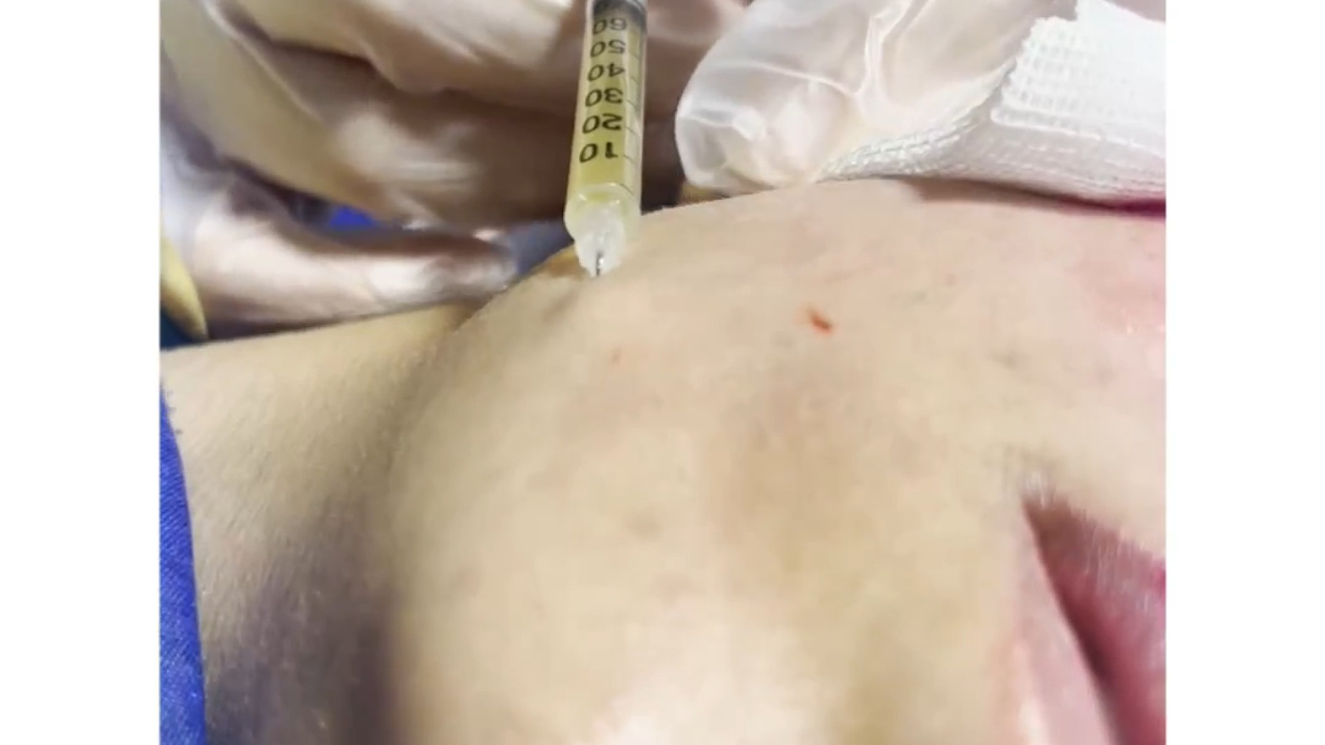 انجام prp دکتر صدیقه نائیجی | متخصص پوست و مو در قم