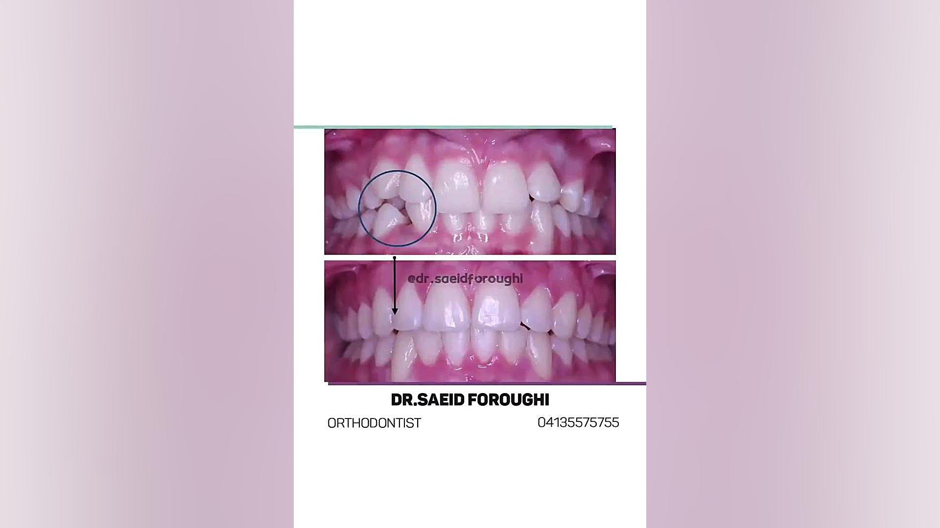 درمان نهفتگی دندان نیش سمت چپ فک بالا دکتر سعید فروغی متخصص ارتودنسی