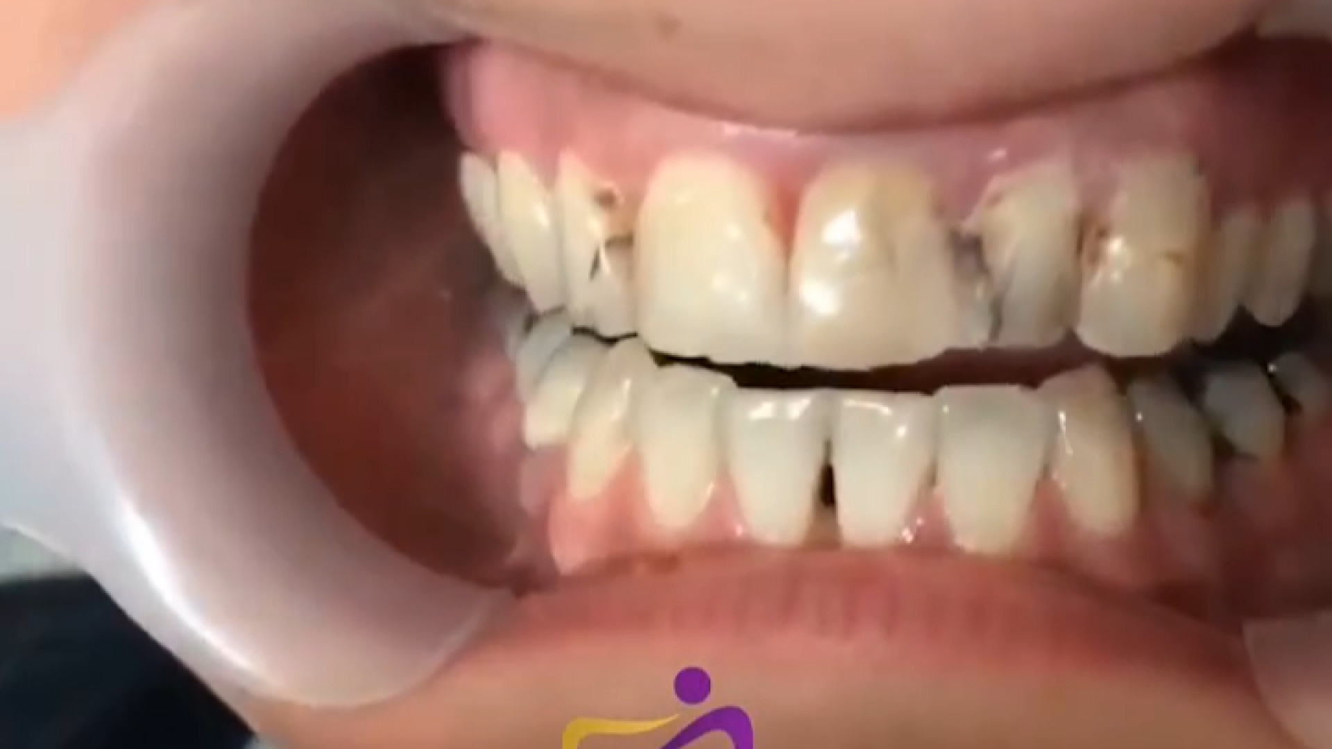 اصلاح طرح لبخند زیبایی دکتر ندا هادی-دندانپزشک زیبایی