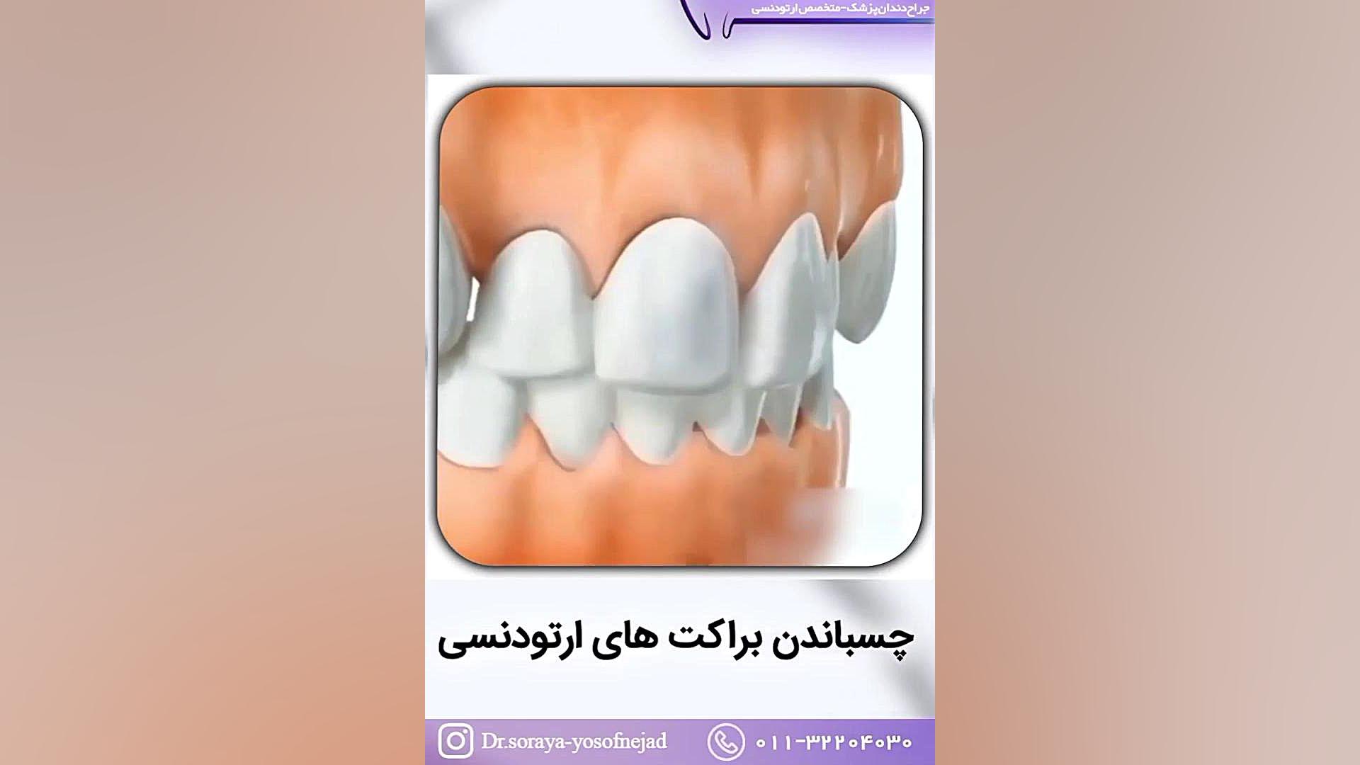 نحوه چسباندن براکت ارتودنسی دکتر ثریا یوسف نژاد متخصص ارتودنسی بابل