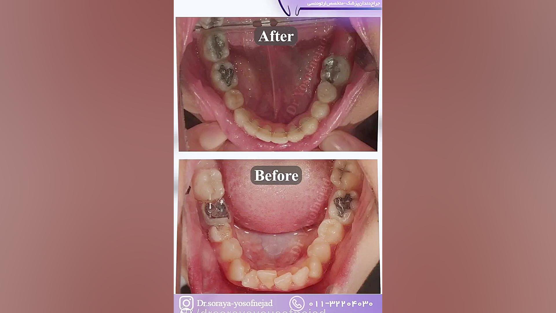 درمان ارتودنسی ثابت دکتر ثریا یوسف نژاد متخصص ارتودنسی بابل