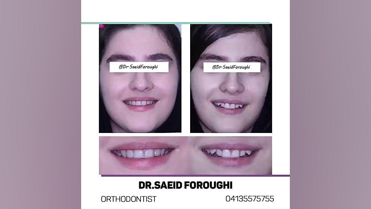 رفع بی نظمی دندانهای فک بالا و چفت کردن دندانهای دو فک توسط ارتودنسی ثابت دکتر سعید فروغی متخصص ارتودنسی