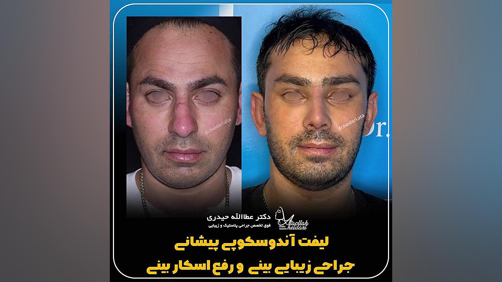 لیفت آندوسکوپی پیشانی ، جراحی بینی و رفع اسکار بینی بیماری شوگرن