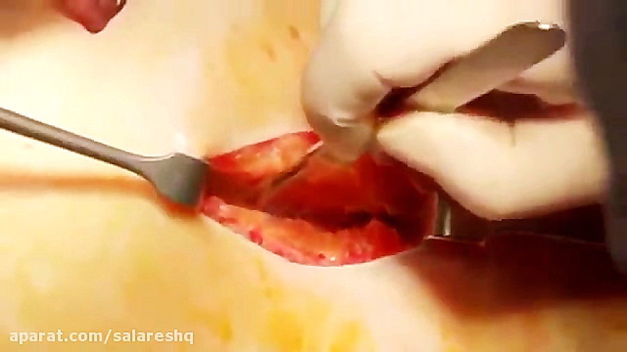جراحی فوق پیشرفته سرطان روده قسمت سوم عمل کولوستومی اتوپلاستی