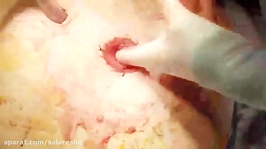 جراحی فوق پیشرفته سرطان روده قسمت چهارم عمل کولوستومی پاکسازی پوست