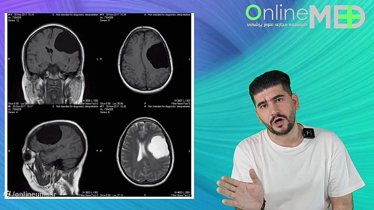 تشخیص آسان کیست آرکنوئید در MRI در سه دقیقه بازی کامپیوتری