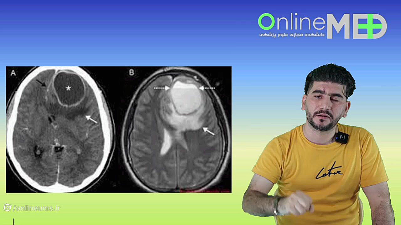 آبسه مغزی در MRI در سه دقیقه ترانه علیدوستی