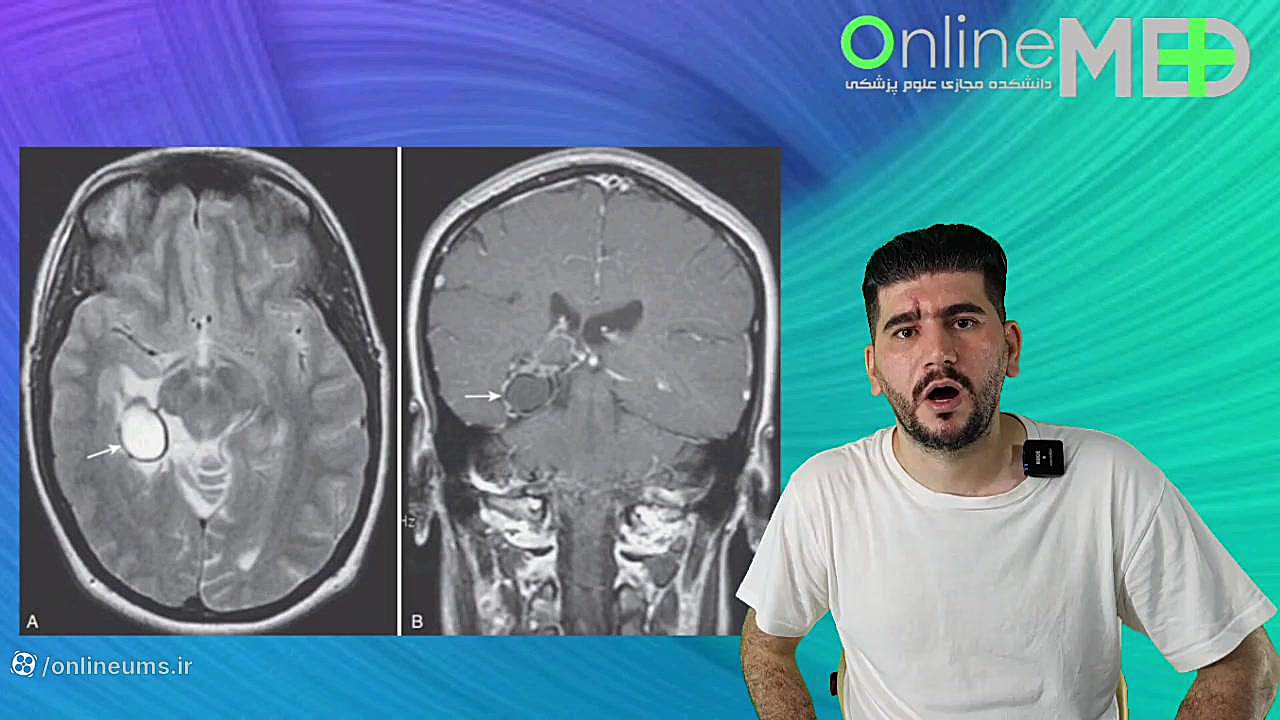 تشخیص آسان گانگلیوما در MRI ویدیوی وایرال