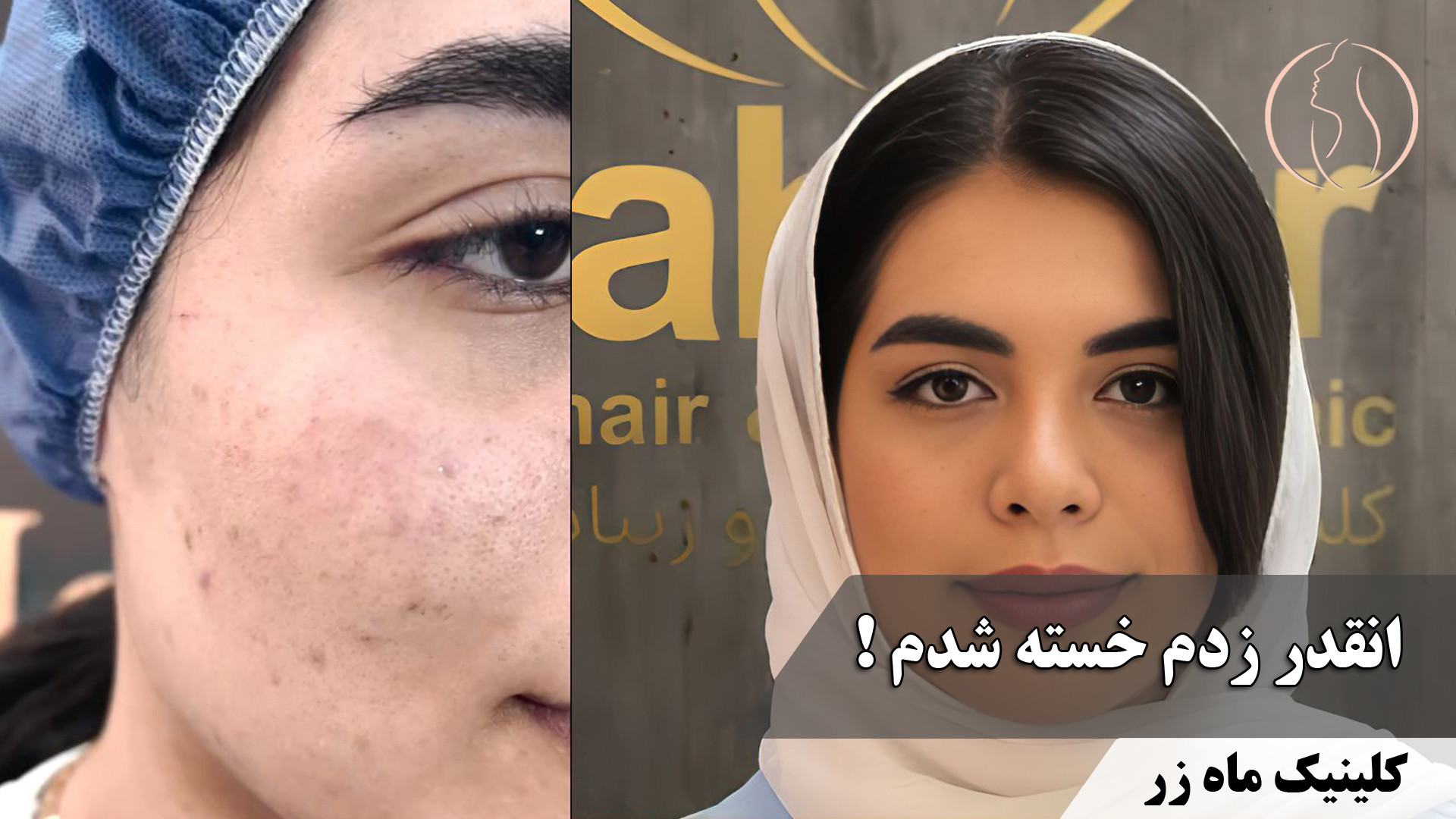 انقدر زدم که خسته شدم! ( کلینیک زیبایی ماه زر ) برداشتن زگیل