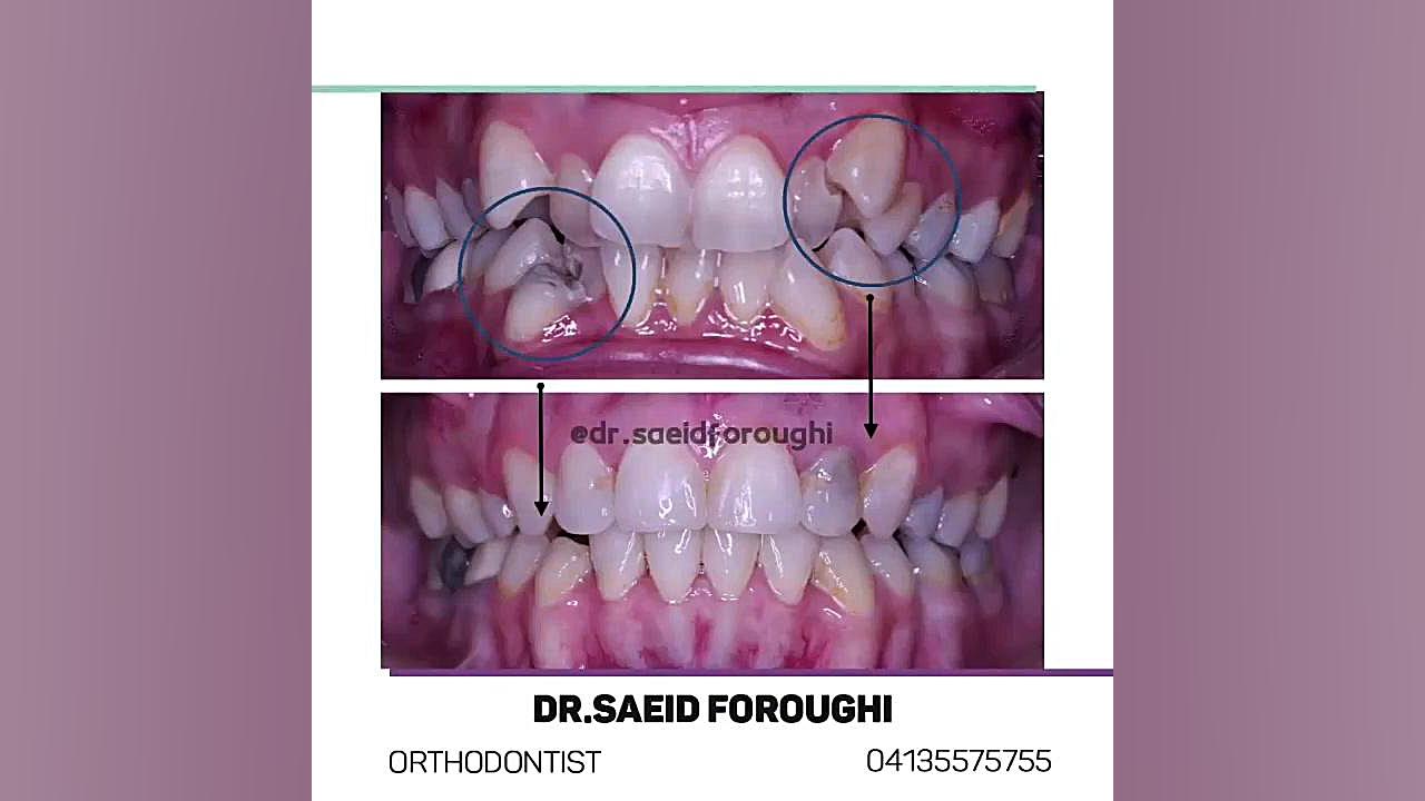 درمان بی نظمی شدید دندانهای فک بالا و پایین دکتر سعید فروغی متخصص ارتودنسی