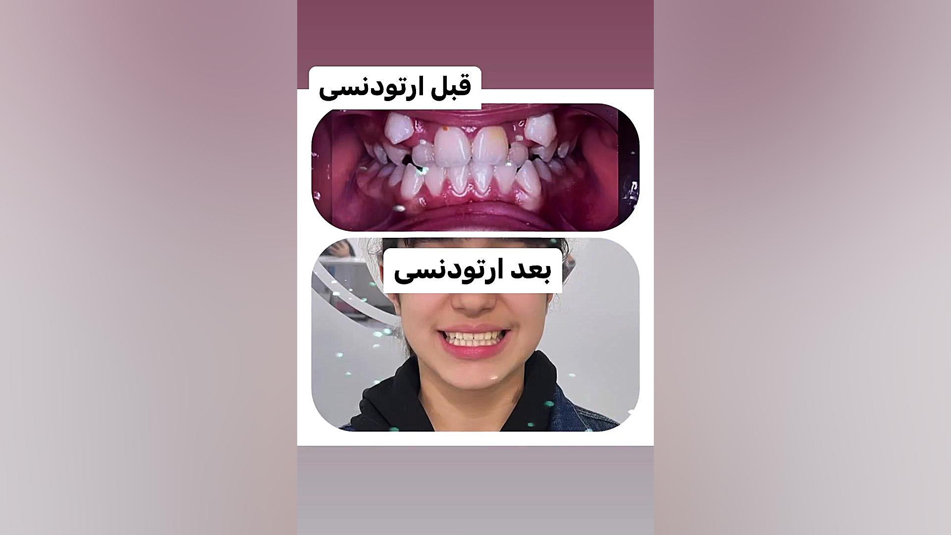 قبل و بعد ارتودنسی دكتر مهدي فهيمي هنزائي