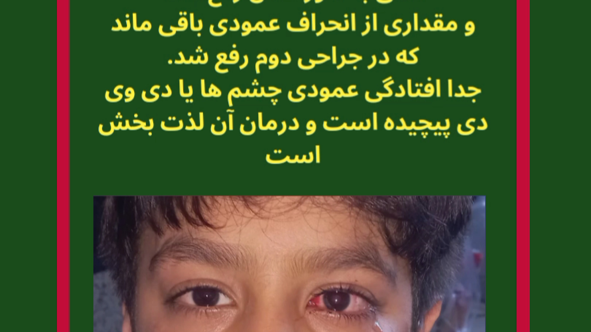 جراحی انحراف چشم کودک بدون بیهوشی عمومی دکتر گزین فوق تخصص استرابیسم عمل زیبایی