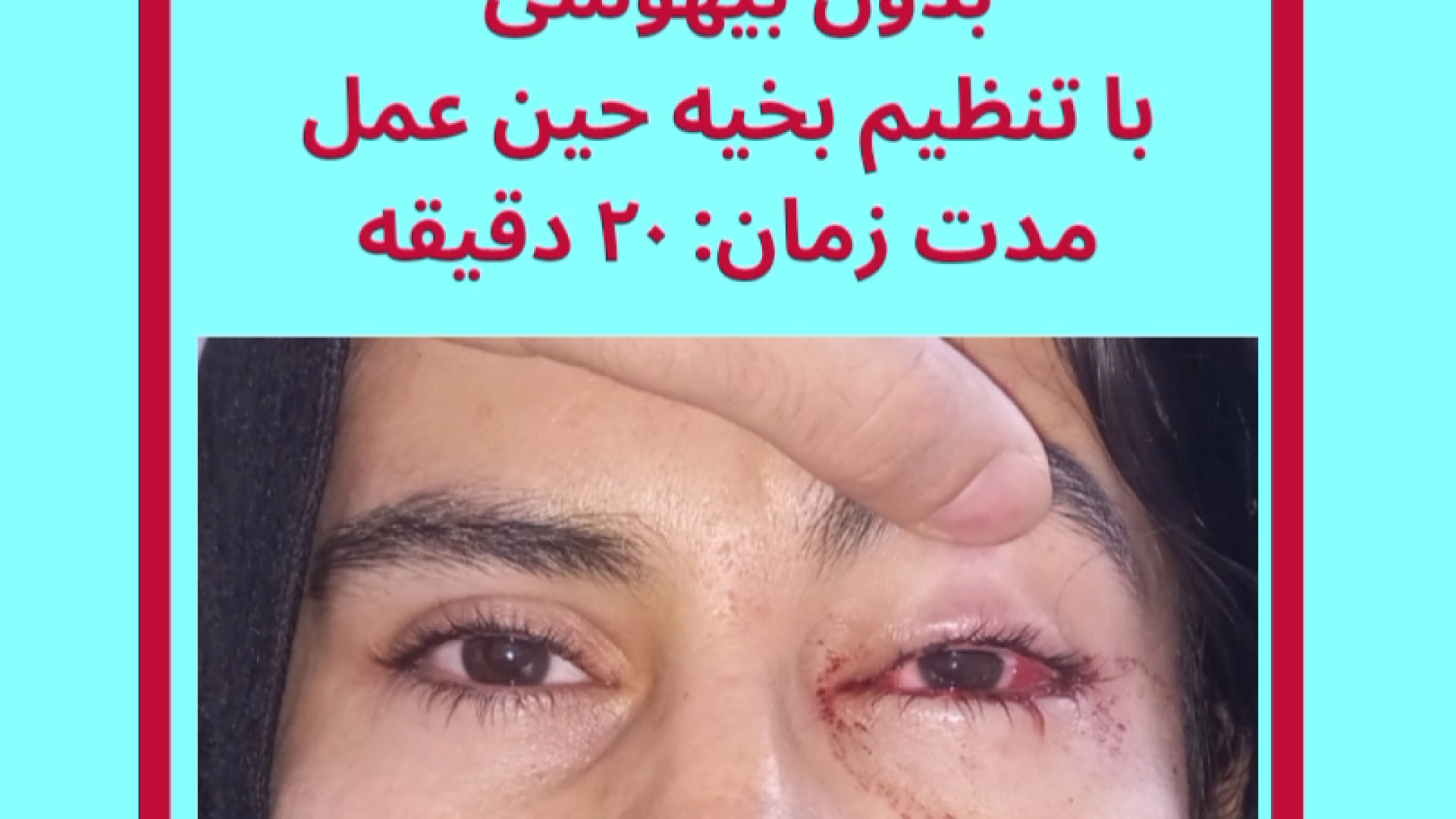 جراحی انحراف چشم بدون بیهوشی عمومی دکتر گزین بهترین فوق تخصص انحراف چشم رفع غبغب
