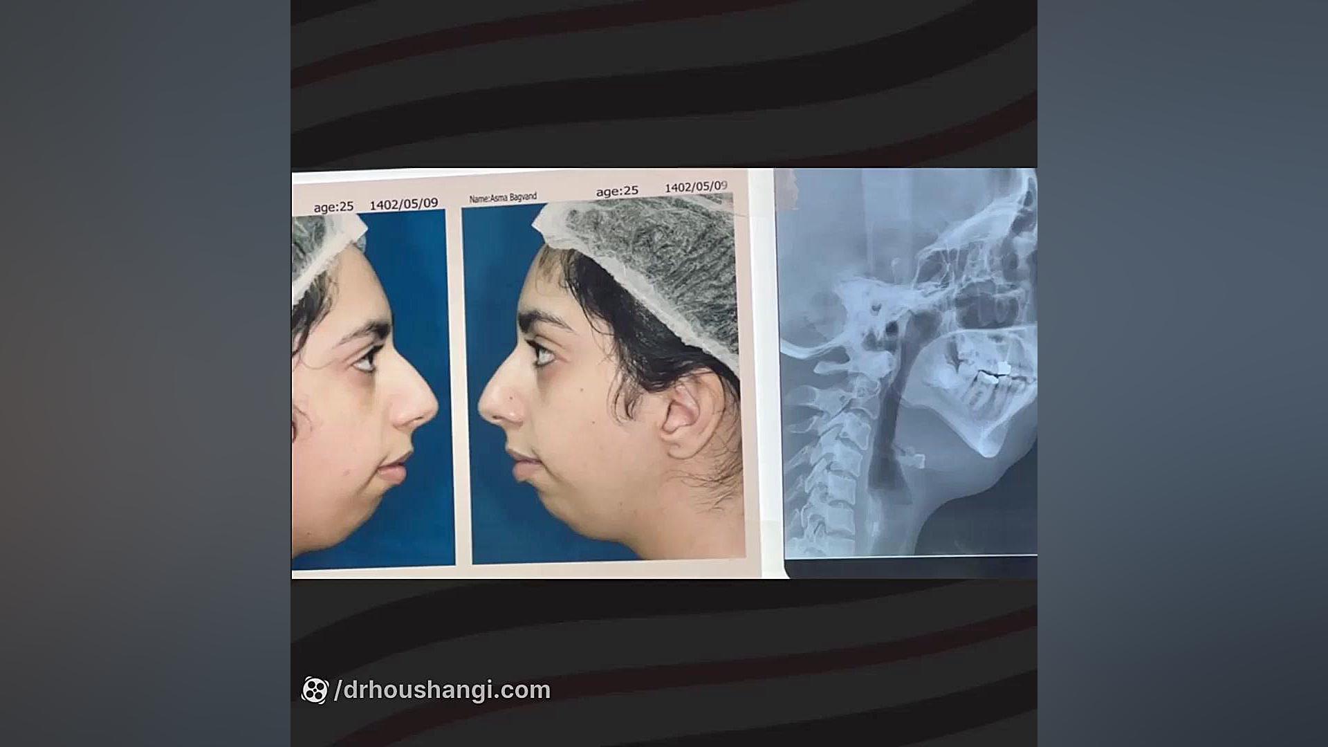 نمونه جراحی فک و صورت در تهران Ribo-Seq