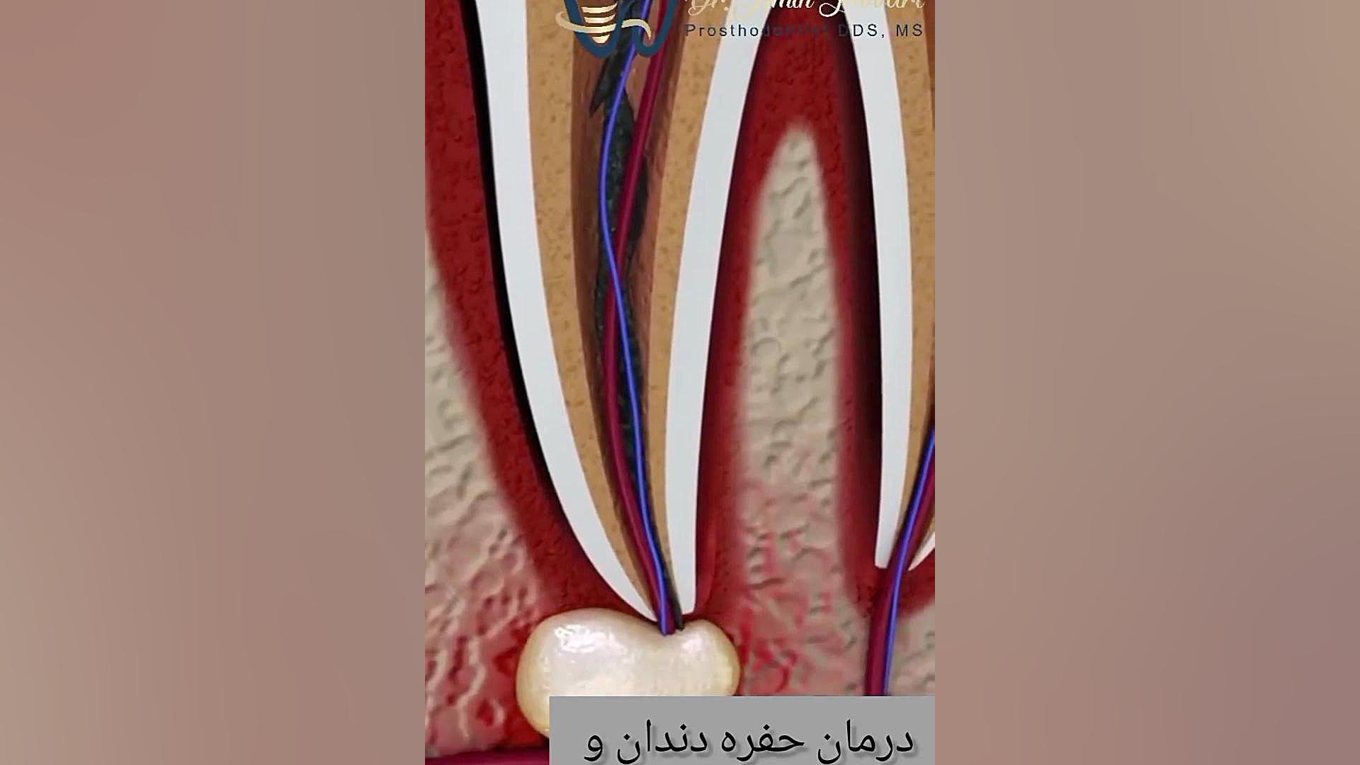 درمان حفره دندان دکتر امین جباری