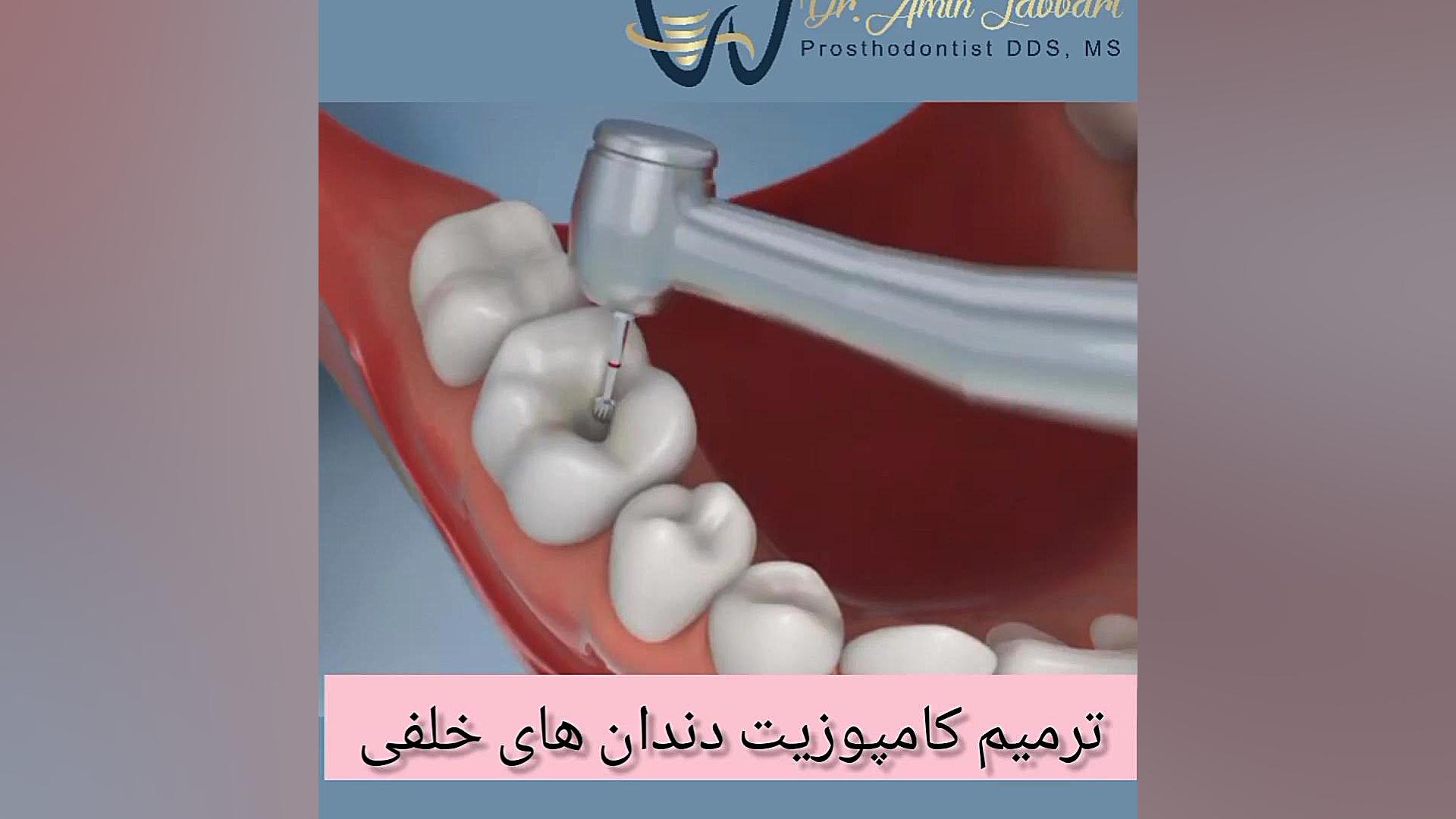 ترمیم کامپوزیت دندان دکتر امین جباری