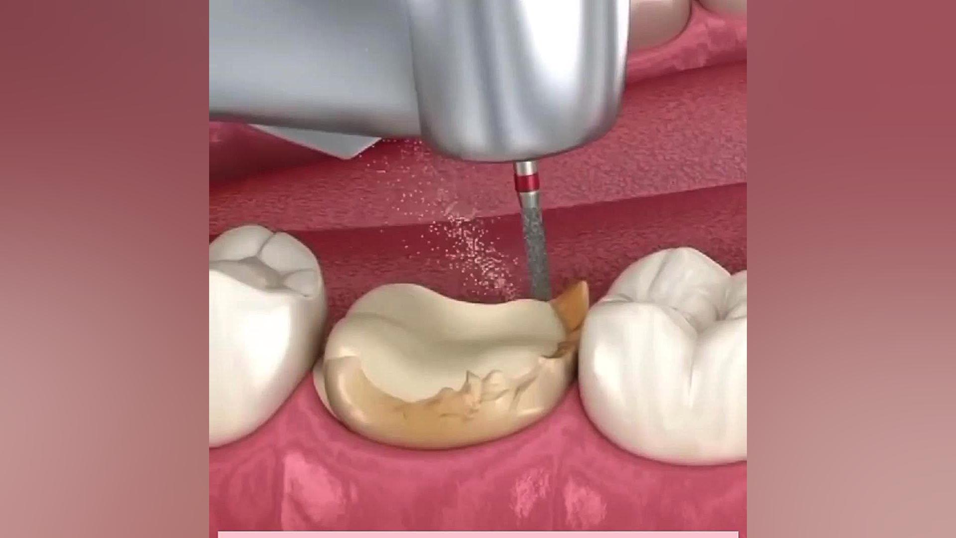 مراحل برداشت پوسیدگی دندان پزشکی تله‌مدیسین تخصصی