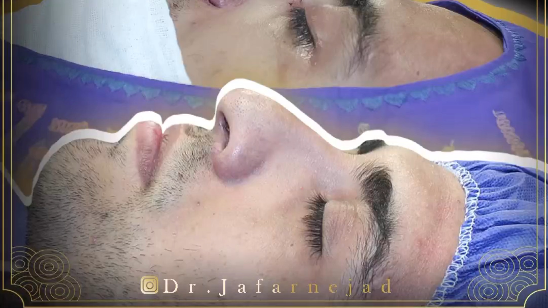 عمل بینی طبیعی دکتر بابک جعفرنژاد