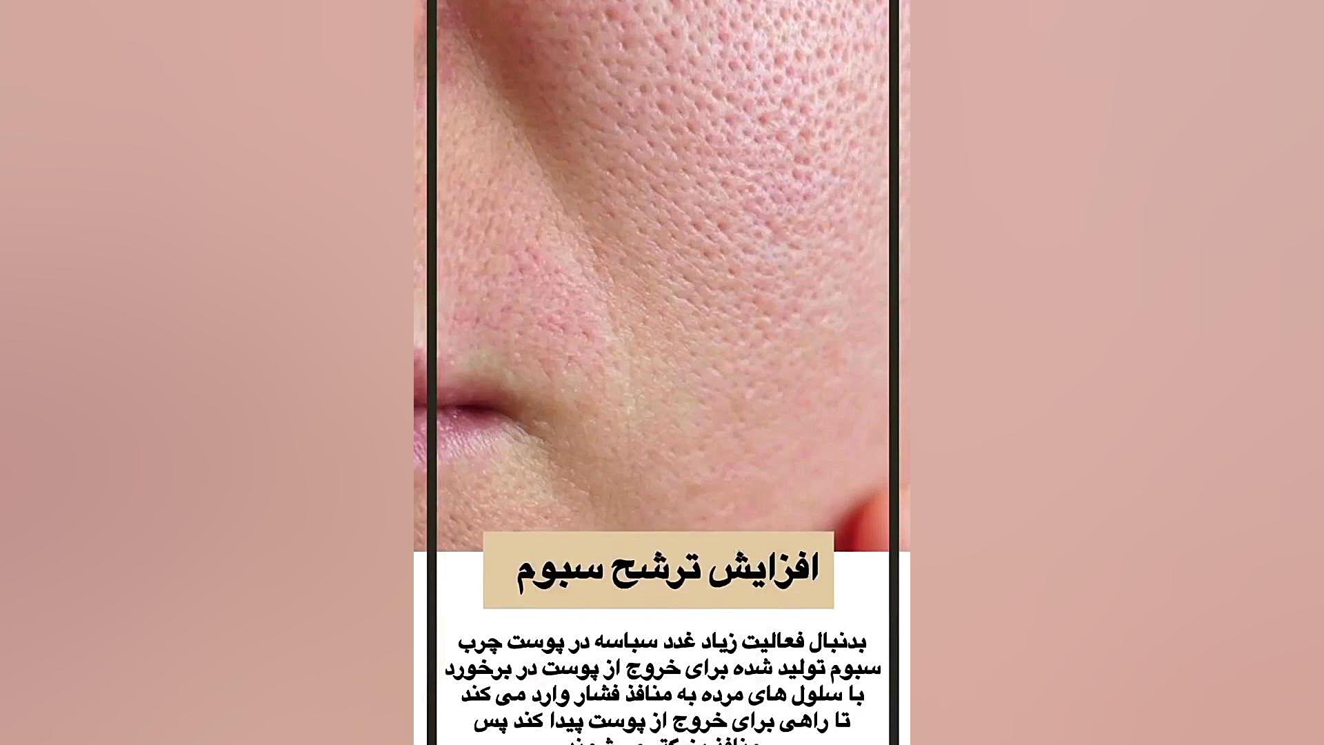 علت منافذ باز پوست دکتر امیر سلیمانی
