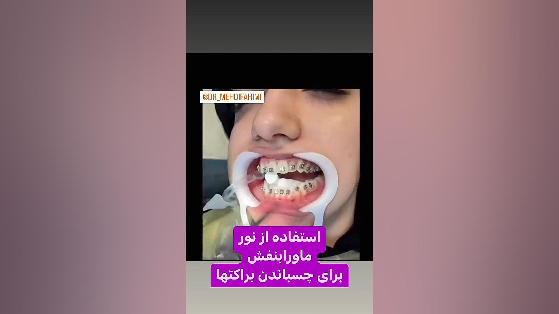 لایت کیور ارتودنسی دكتر مهدي فهيمي هنزائي