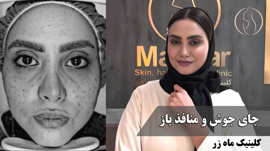 از بین بردن جای جوش و منافذ باز ( کلینیک ماه زر )