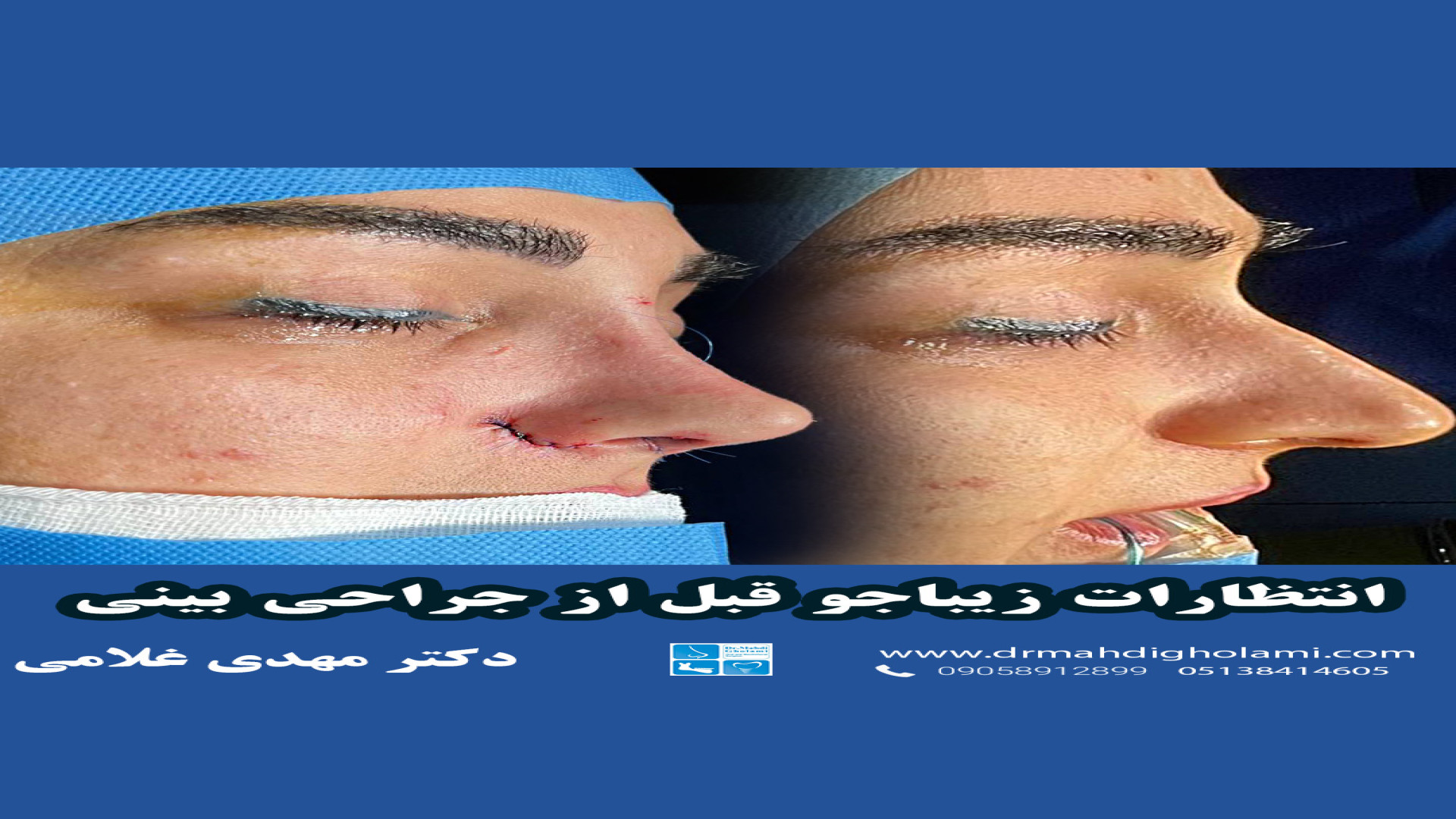 انتظارات زیباجو قبل از جراحی بینی دکتر مهدی غلامی
