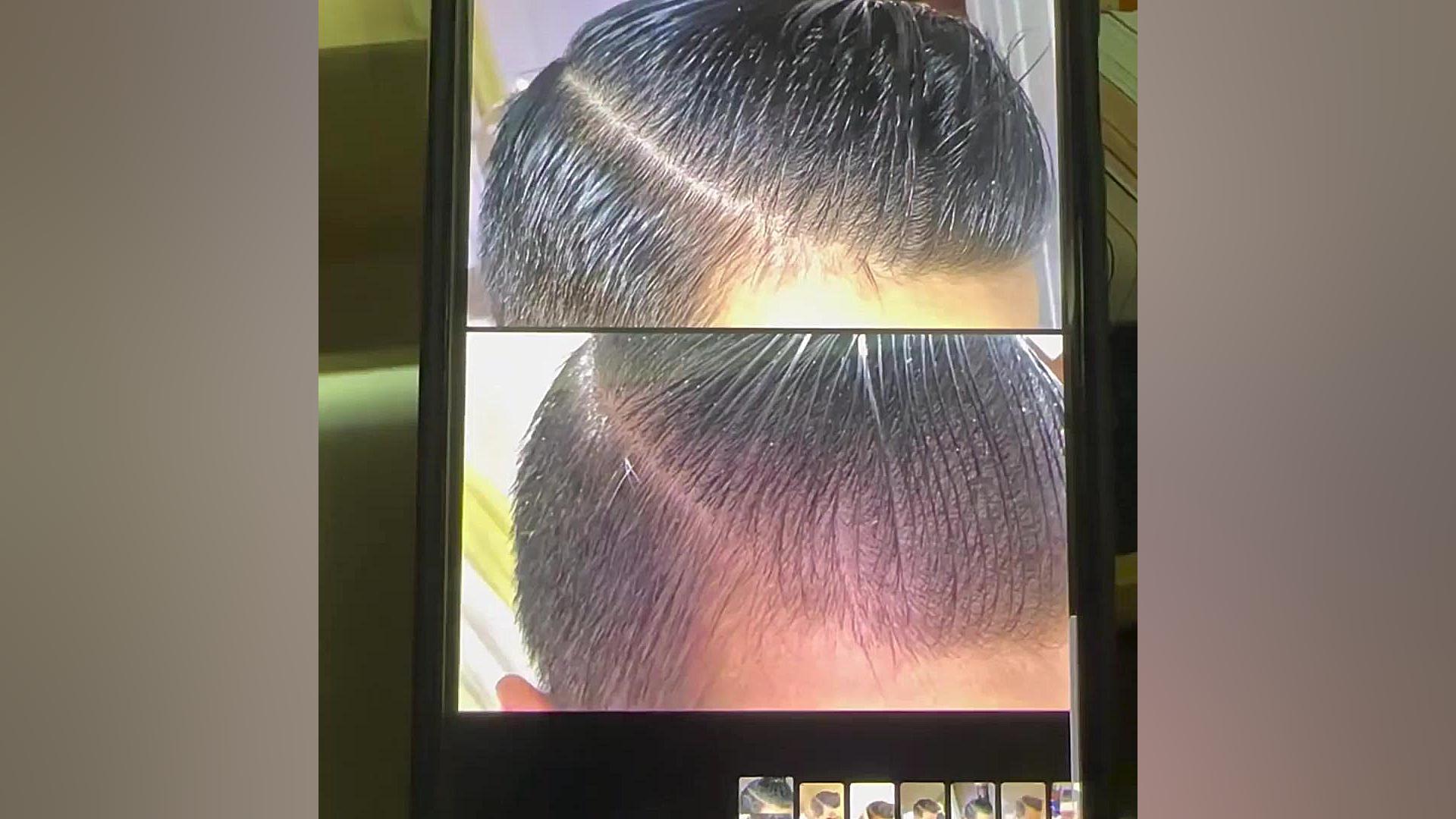 نتیجه درمان ریزش مو عکس فبل و بعد از دو ماه درمان دکتر فرحناز زینعلی - متخصص پوست، مو، زیبایی زنجان