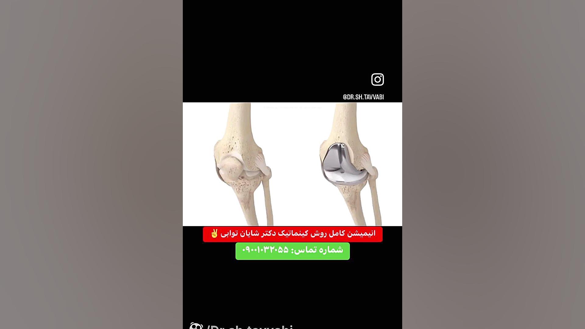 جراحی تعویض مفصل زانو به روش جدید کینماتیک دکتر شایان توابی جراح زانو و لگن برداشتن زگیل