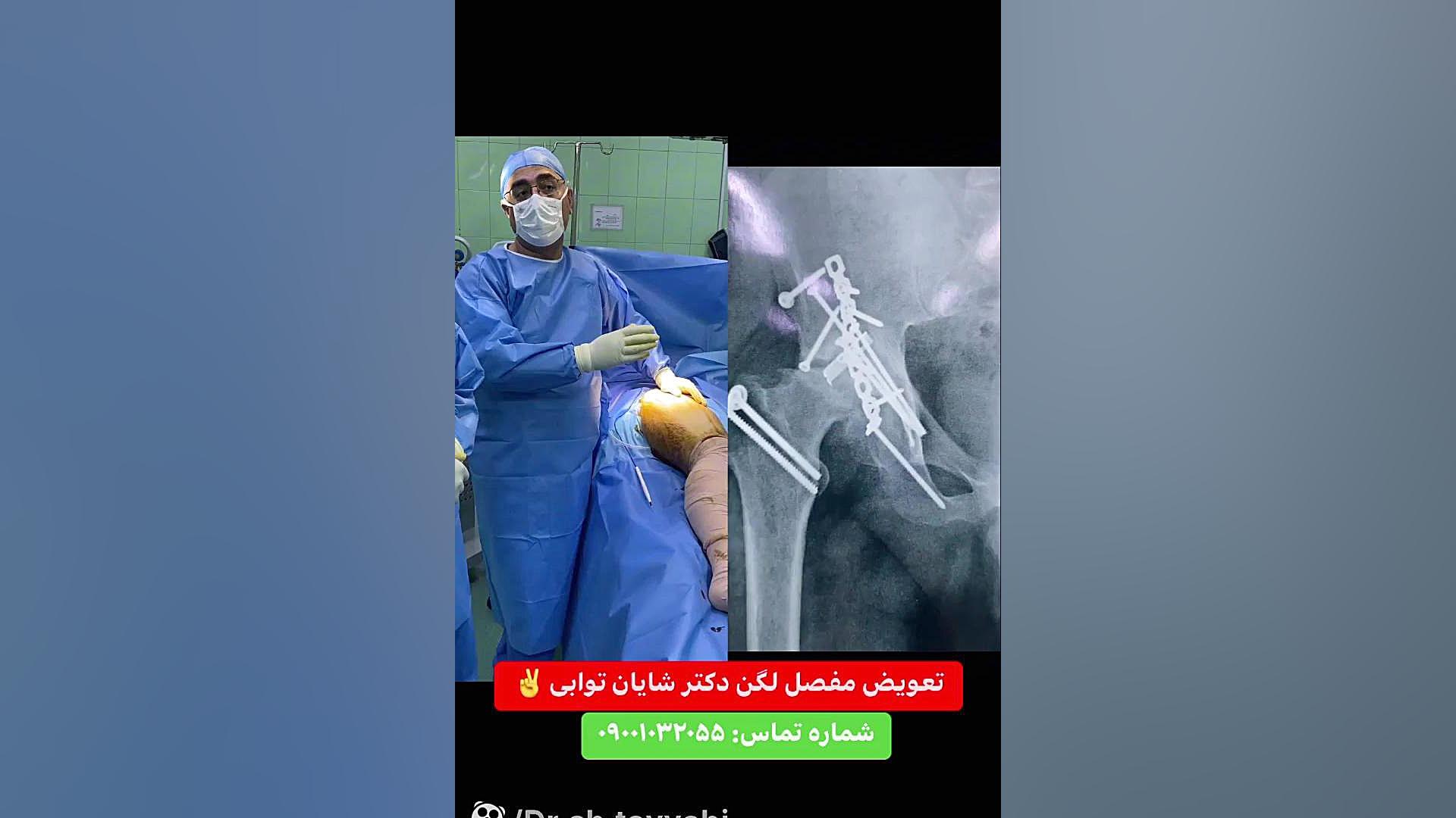 جراحی تعویض مفصل لگن به دنبال شکستگی قبلی مفصل دکتر شایان توابی لیزر موهای زائد