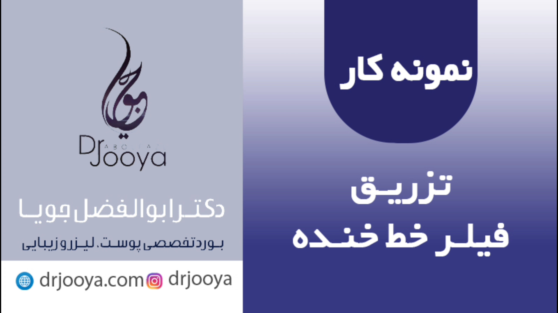 تزریق فیلر خط خنده | بهترین متخصص زیبایی اصفهان دکتر ابوالفضل جویا