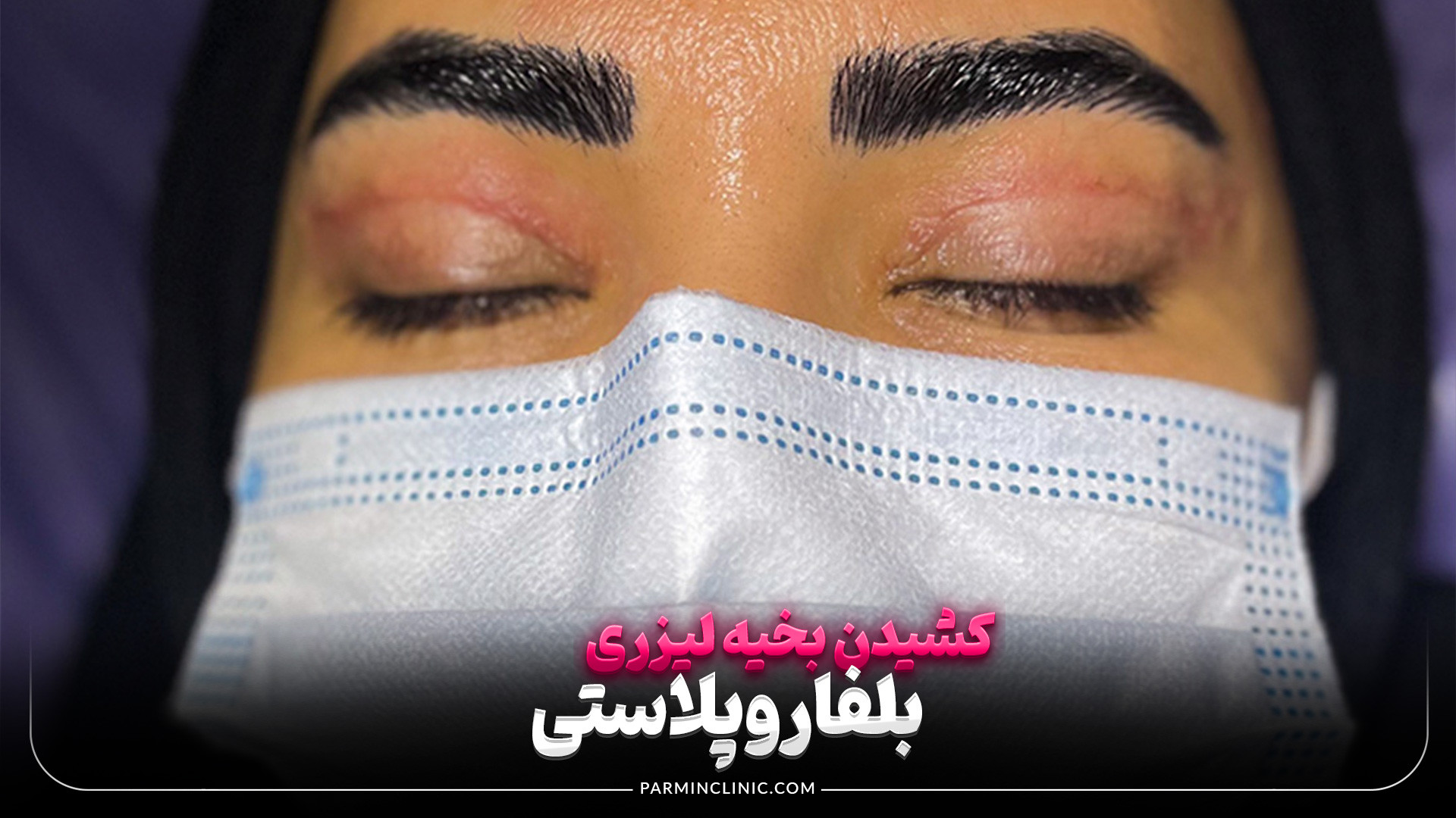 کشیدن بخیه لیزری بلفاروپلاستی در کلینیک زیبایی پارمین مهندسی ژنوم انسانی