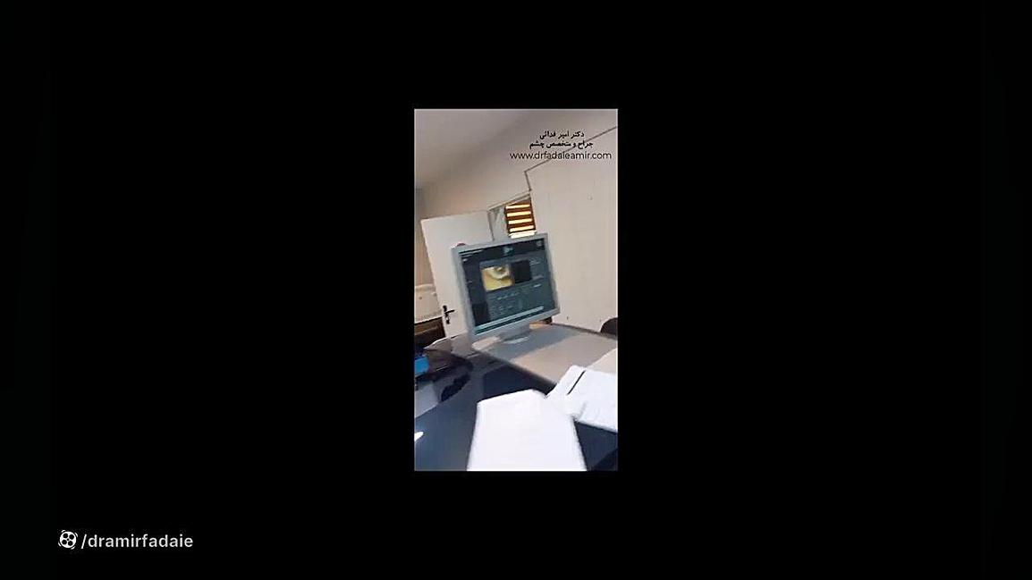 عمل لازک توسط دکتر امیر فدائی دکتر امیر فدایی