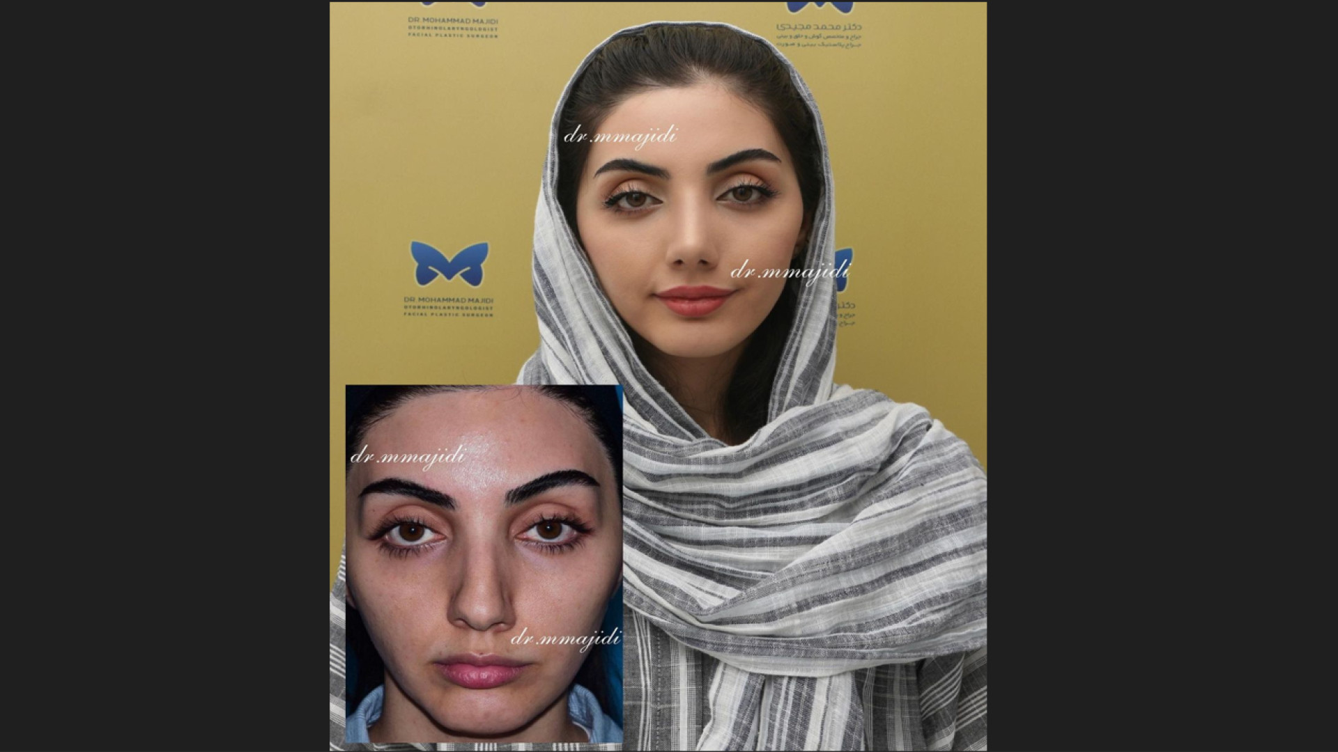 بینی طبیعی شیک - یک ماه پس از عمل بینی غضروفی- استخوانی دکتر محمد مجیدی - جراحی بینی به سبک طبیعی شیک