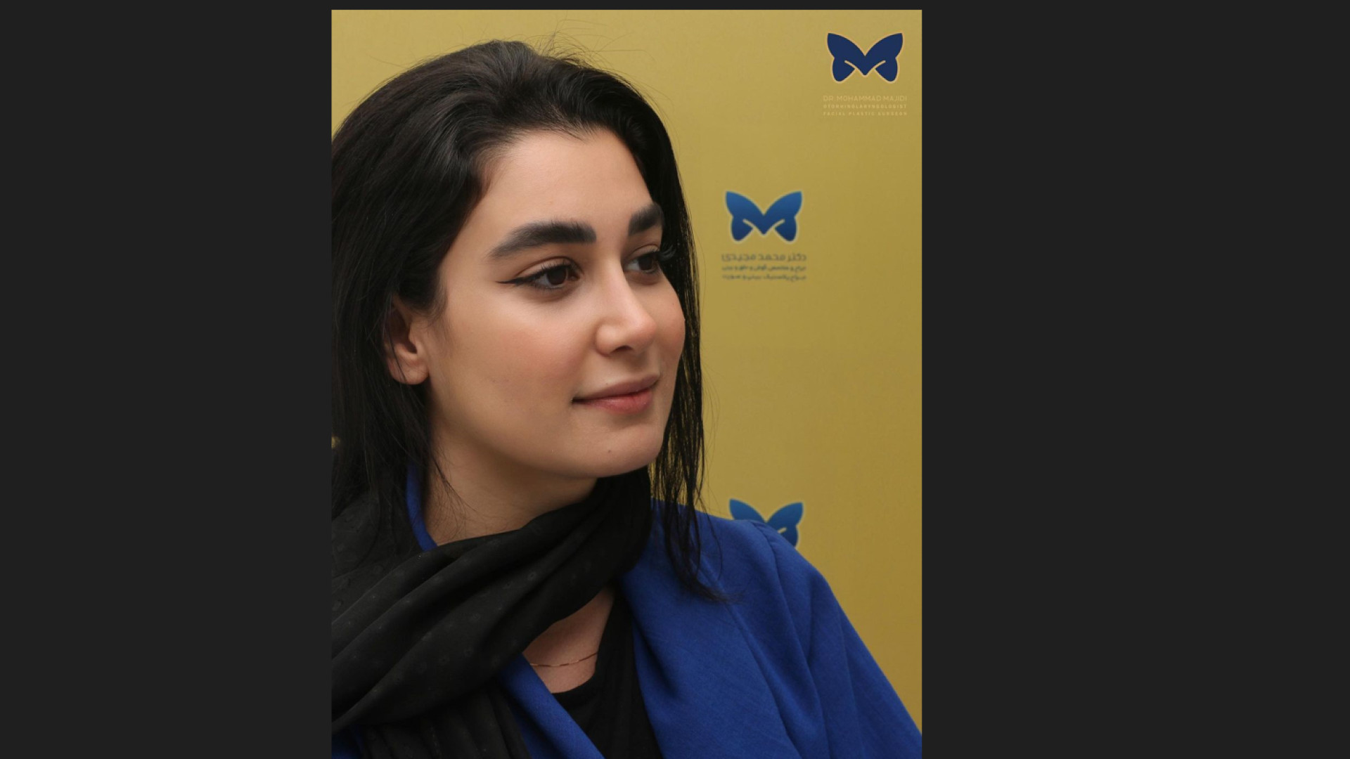 عمل انحراف بینی استخوانی - نتیجه بعد از یکسال دکتر محمد مجیدی - جراحی بینی به سبک طبیعی شیک