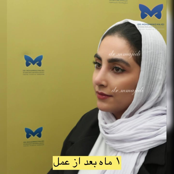 نتیجه عالی نچرال رینوپلاستی - یک ماه پس از جراحی بینی دکتر محمد مجیدی - جراحی بینی به سبک طبیعی شیک