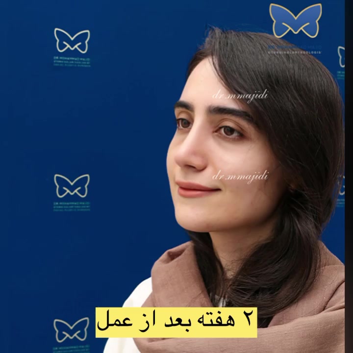 2 هفته بعد از عمل بینی نسبتا گوشتی به فرم طبیعی دکتر محمد مجیدی - جراحی بینی به سبک طبیعی شیک
