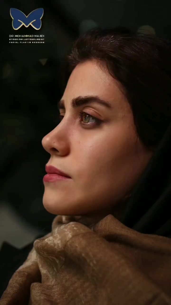 نتیجه زیبایی عمل بینی پس از 6 ماه دکتر محمد مجیدی - جراحی بینی به سبک طبیعی شیک