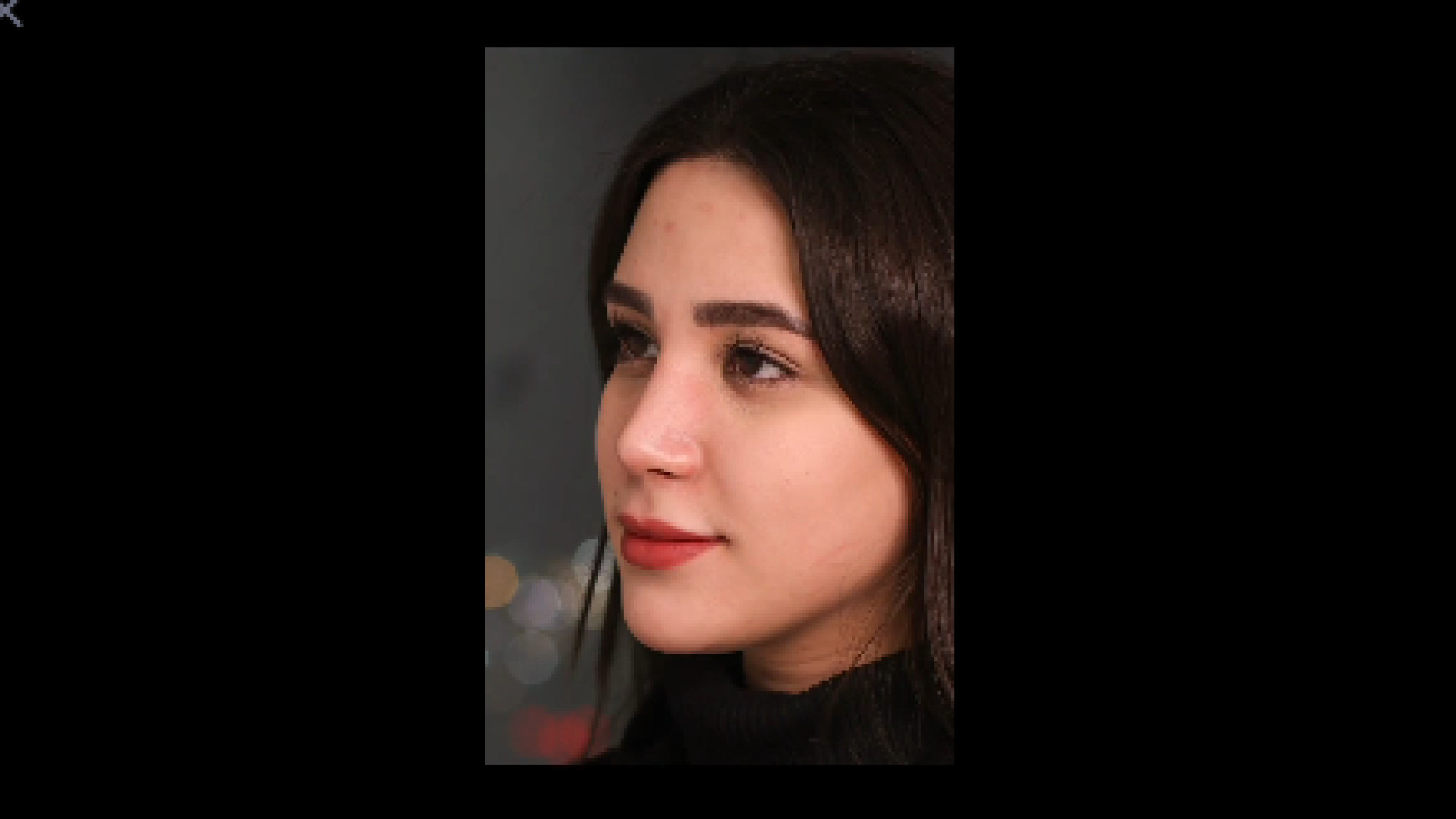 4 ماه پس از عمل زیبایی بینی گوشتی به سبک طبیعی دکتر محمد مجیدی - جراحی بینی به سبک طبیعی شیک