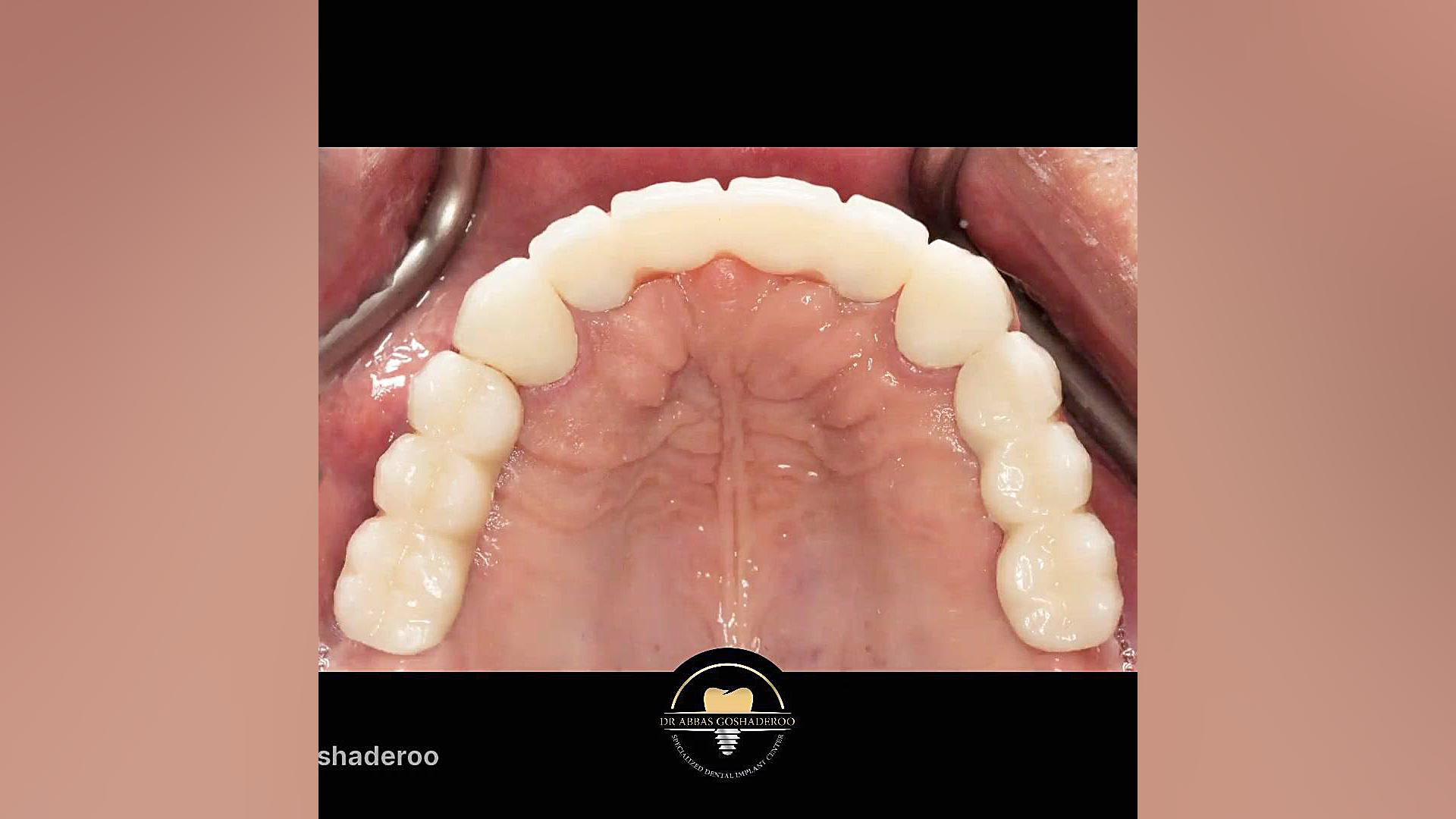 بازسازی کامل دهان با کاشت ایمپلنت دکتر عباس گشاده رو، متخصص جراحی لثه و ایمپلنت