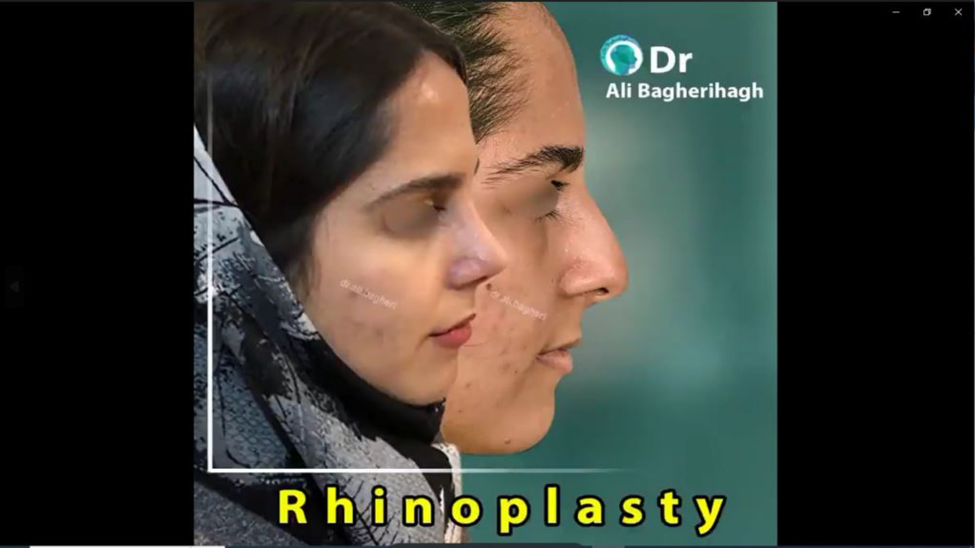 جراحی زیبایی بینی | دکتر باقری حق دکتر علی باقری حق