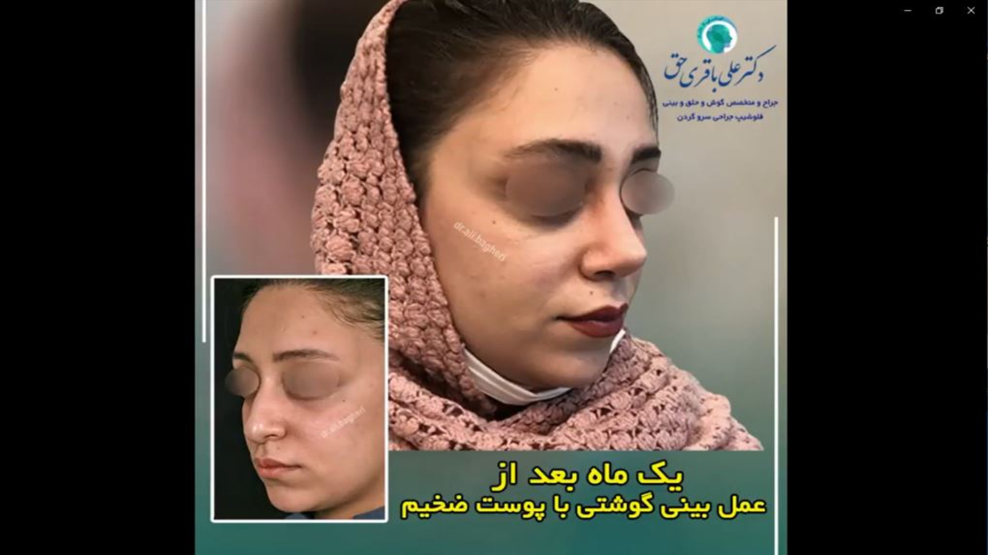 جراحی بینی گوشتی پوست ضخیم | دکتر باقری حق دکتر علی باقری حق