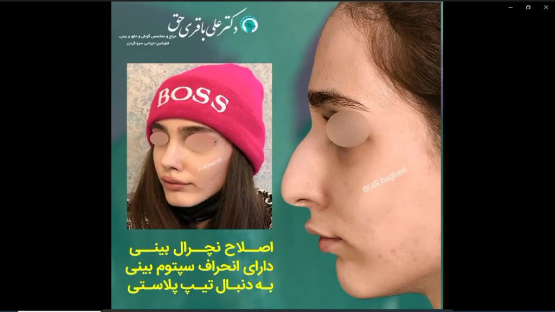 جراحی انحراف بینی | دکتر باقری حق دکتر علی باقری حق