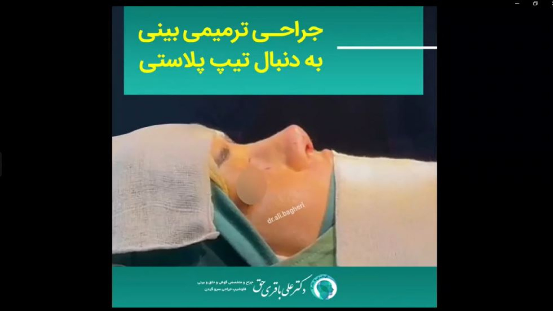 جراحی ترمیمی بینی تیپ پلاستی | دکتر باقری حق دکتر علی باقری حق