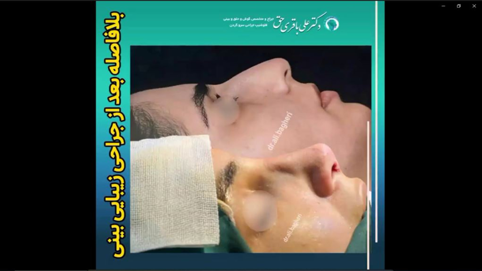 بلافاصله بعد از جراحی زیبایی بینی | دکتر باقری حق دکتر علی باقری حق